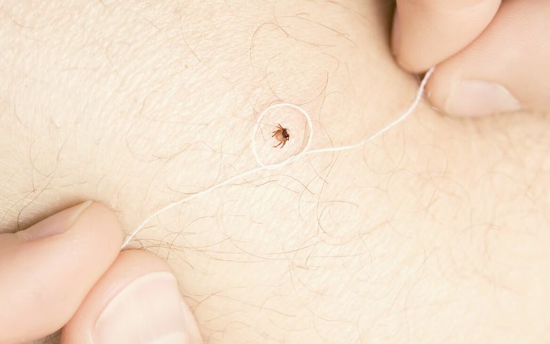 Removing a tick from a human with dental floss