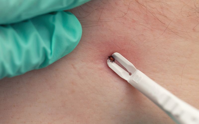 Tweezers pulling out a tick on human skin